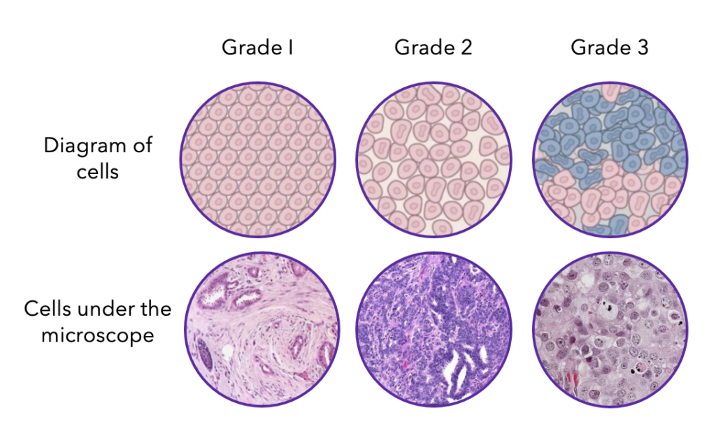 What Is Pre Cancer Cells In Breast